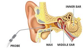 Microsuction ear wax removal diagram